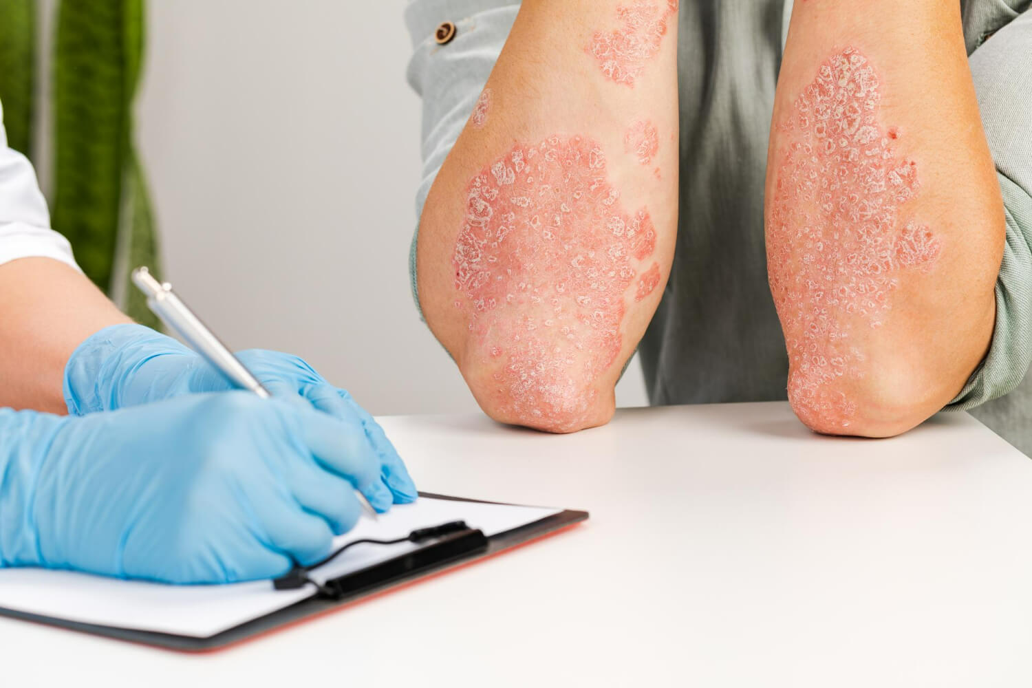 psoriasis tipuri