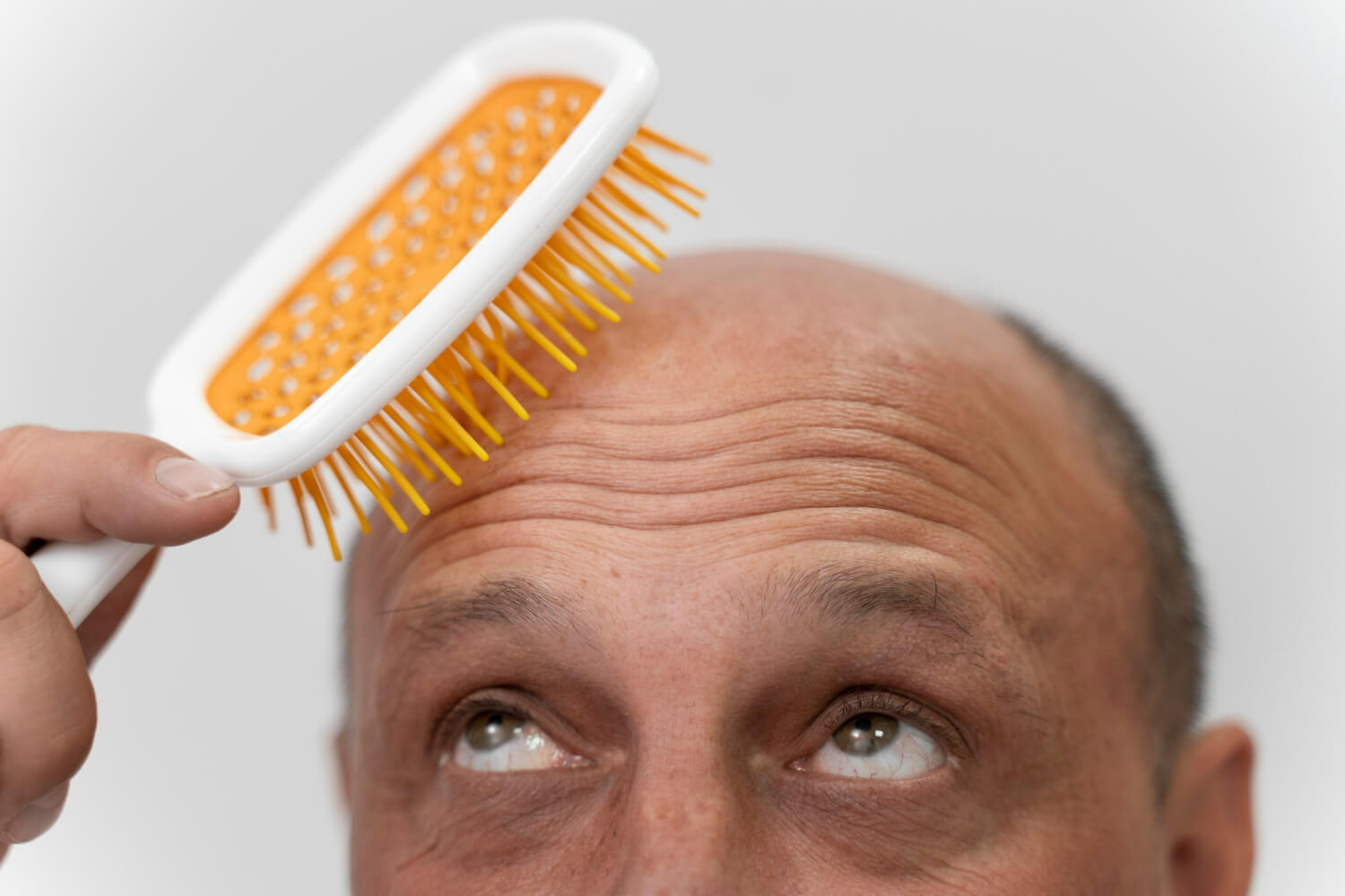 alopecie femei si barbati alopecie femei si barbati