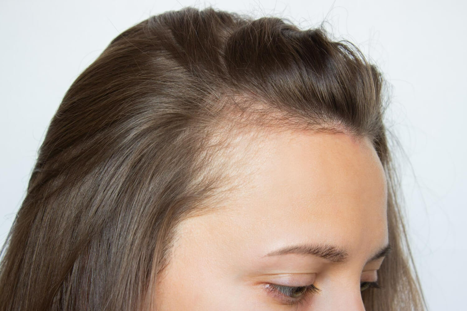 alopecie la femei alopecie la femei